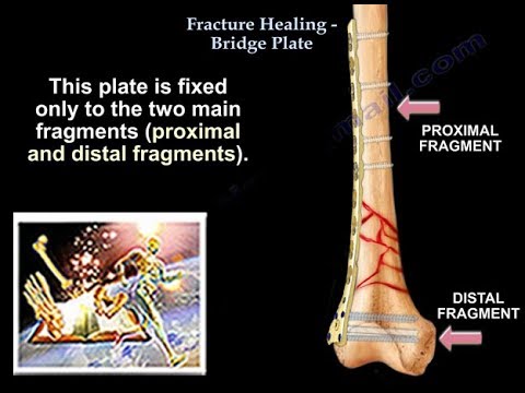Fracture Healing, Bridge Plate - Everything You Need To Know - Dr. Nabil Ebraheim