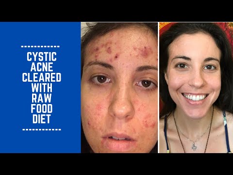 How Amanda Cleared up Cystic Acne with Raw Food Diet