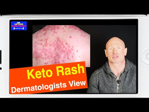 Keto Rash - Ketogenic Rash - Dermatologists View